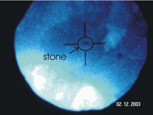 X-ray image of a stone and gas after treatment